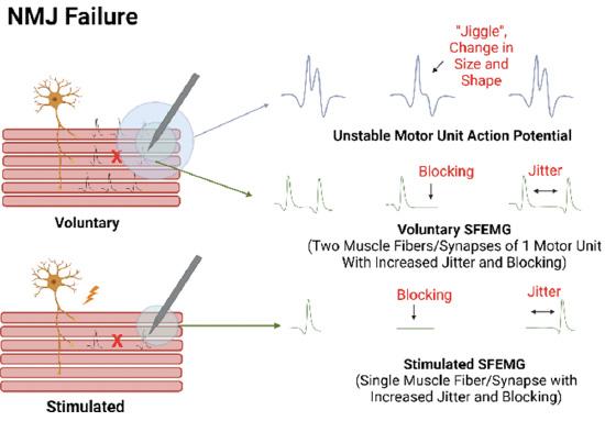 Graph about neuromuscular junction failure