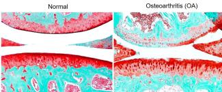 A microscopic scan of normal tissue compared to tissue with osteoarthritis